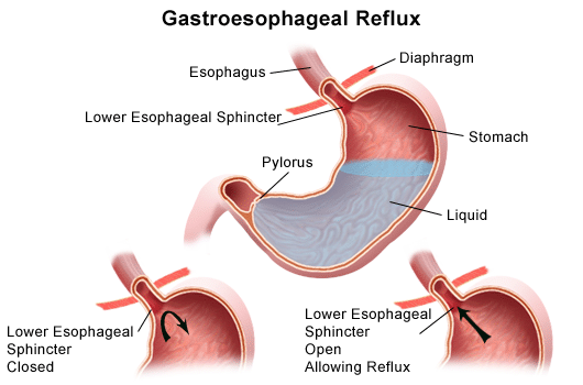 Gastro esophageal reflux